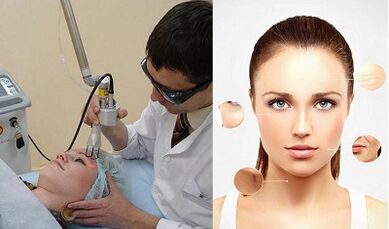 ¿Cómo se realiza el rejuvenecimiento cutáneo con láser