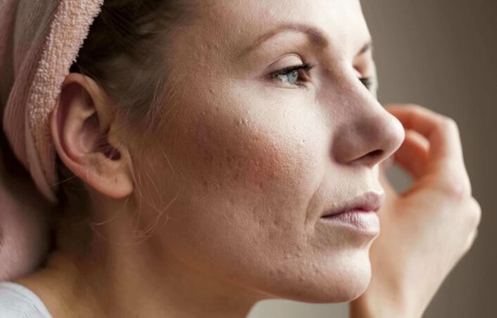 Piel facial problemática que necesita tratamientos antienvejecimiento