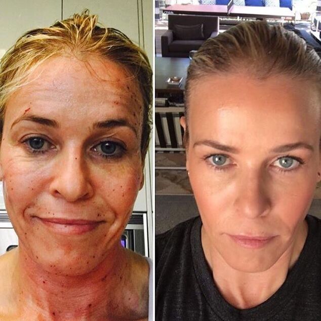 Mujer antes y después del láser fraccionado (eliminación de focos de hiperpigmentación)